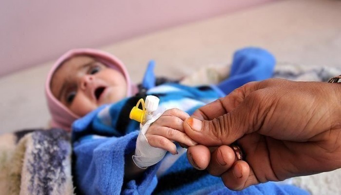 الأمم المتحدة: نصف أطفال اليمن يعانون سوء التغذية المزمن