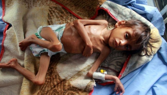 تحذير أممي من وضع مأساوي باليمن ينذر بوفاة آلاف الأطفال